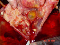 This shows that the tumor had encased all the organs in the abdomen, the gall bladder, the liver,&nbsp;and the intestinal track