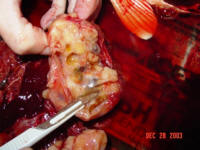 This shows that the tumor had encased all the organs in the abdomen, the gall bladder, the liver,&nbsp;and the intestinal track