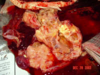 This shows that the tumor had encased all the organs in the abdomen, the gall bladder, the liver,&nbsp;and the intestinal track