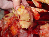 the tumor had encased all the organs in the abdomen, the gall bladder, the liver,&nbsp;and the intestinal track